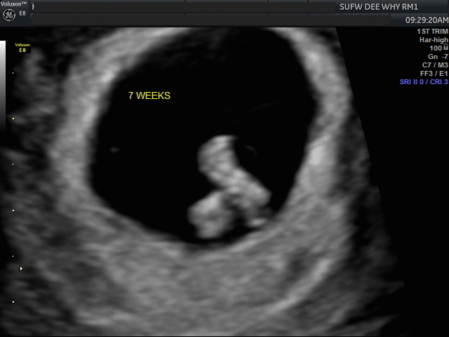Expect what 9 to ultrasound at week 6 week