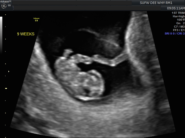 6 4 ultrasound heartbeat days weeks for date 2022 pregnant best Postterm pregnancy