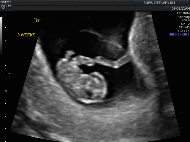 3 ultrasound 4 days weeks 3 Weeks